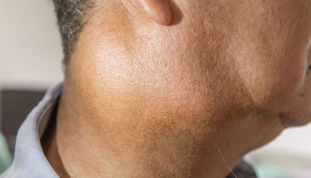 Head and neck lumps_Hero image