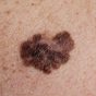 Melanoma,-,A,Malignant,Tumor,Of,The,Skin