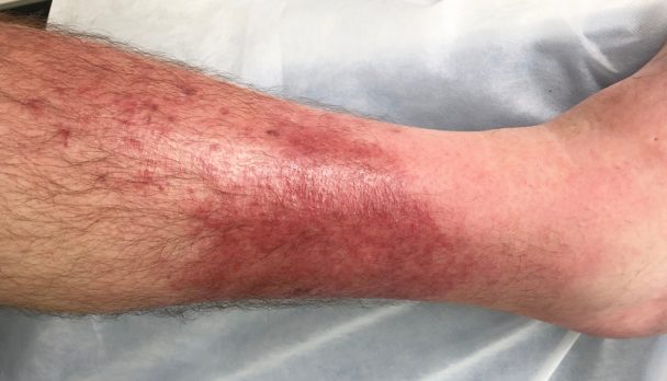 Cellulitis,At,Left,Leg.