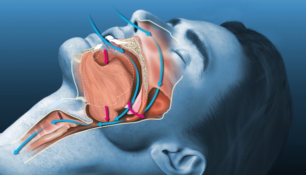 Medically,3d,Illustration,Shows,A,Sleeping,Snoring,Man